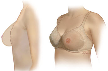 Comfortable Mastectomy Bra, Single Mastectomy Prosthesis Bra